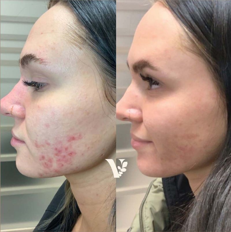 Treatments & Cost Chemical Peels Fargo ND